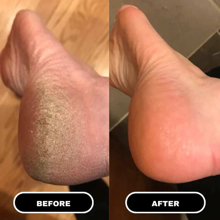 HeelRenew Stick